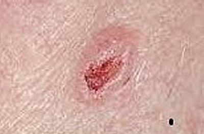 Basalzellkarzinom